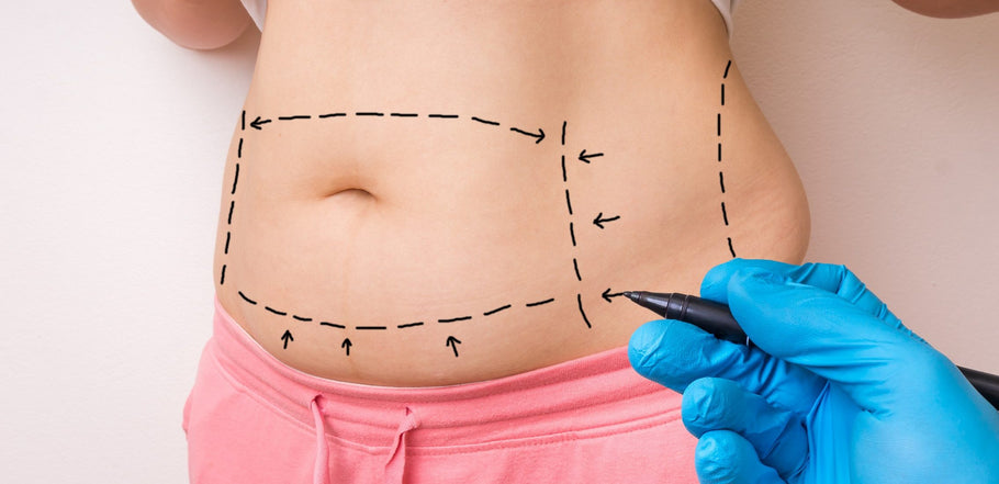 Embarazo luego de una Abdominoplastia